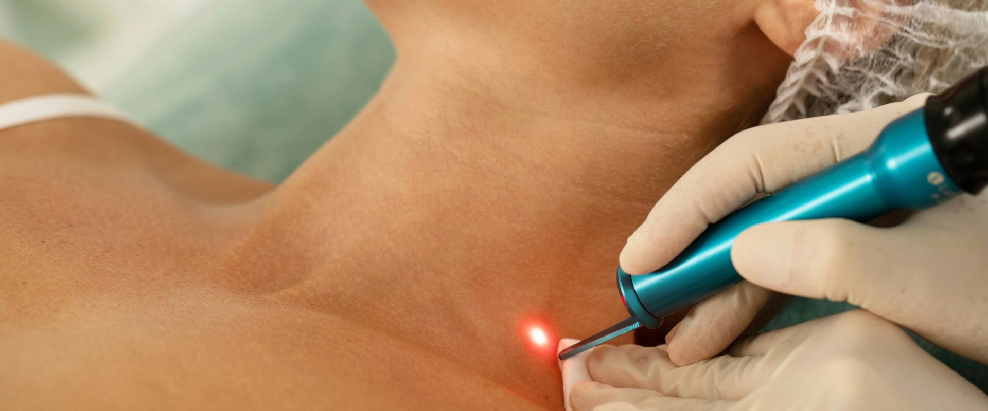Krem po laserze frakcyjnym – jak wybrać najlepszy preparat do pielęgnacji skóry po zabiegu?